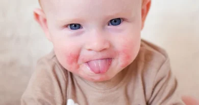 Teething Rash on Face