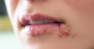 Herpes Photos in Different Stages