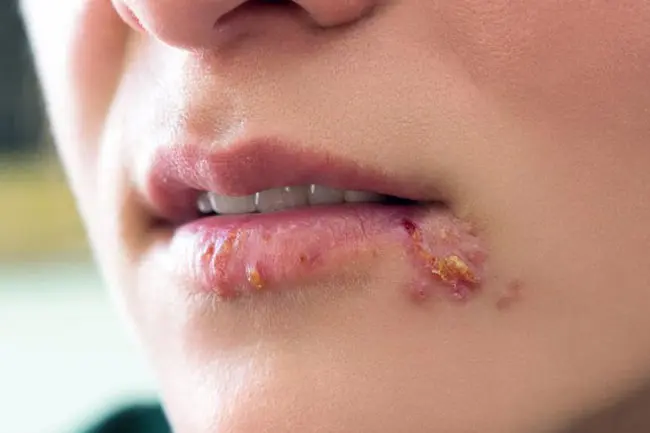 Herpes Photos in Different Stages: Real Pictures, Symptoms & Healing Timeline Explained