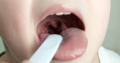Can Allergies Cause Sore Throat