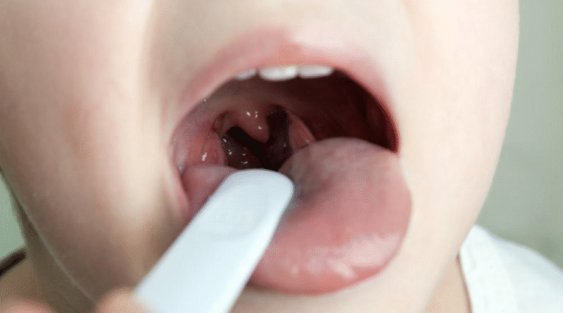 Can Allergies Cause Sore Throat