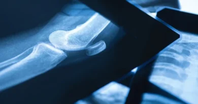 What is the Broken Bone Theory