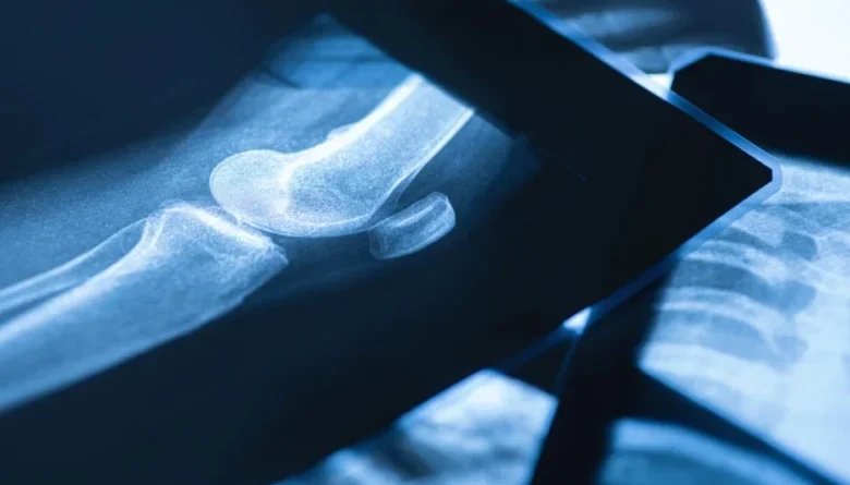 What is the Broken Bone Theory