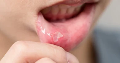 How to Get Rid of a Cold Sore in 24 Hours