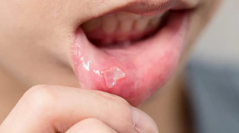 How to Get Rid of a Cold Sore in 24 Hours