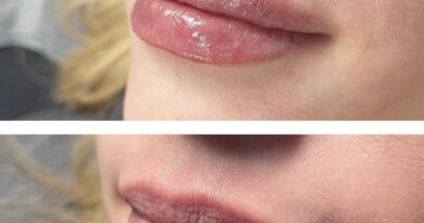 lip flip before and after