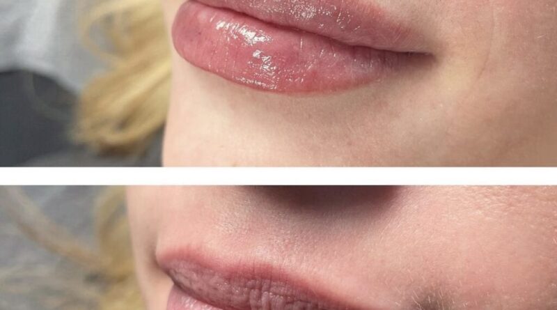 lip flip before and after