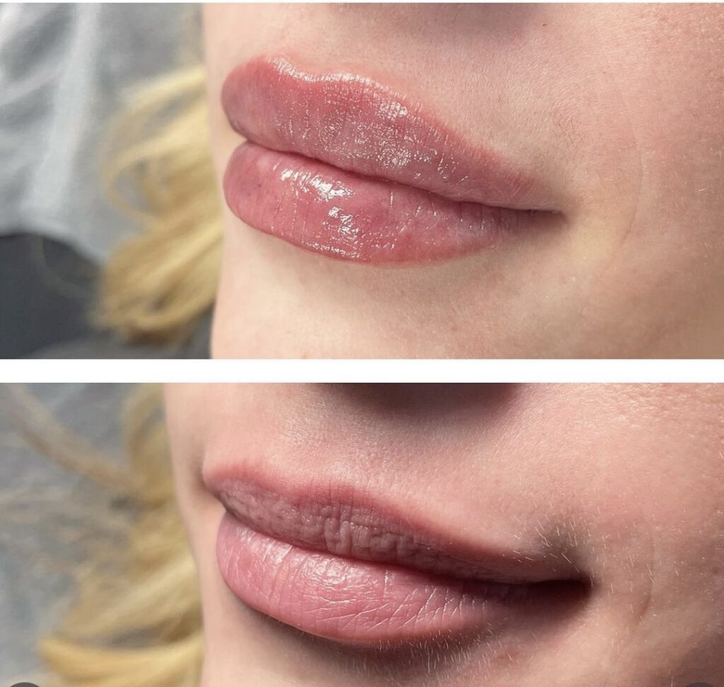 Lip Flip before and after: results, photos, timeline and what to expect (UK Guide to Botox Lip Flip Results)