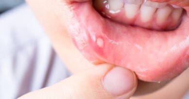 How to Get Rid of a Canker Sore in 24 Hours