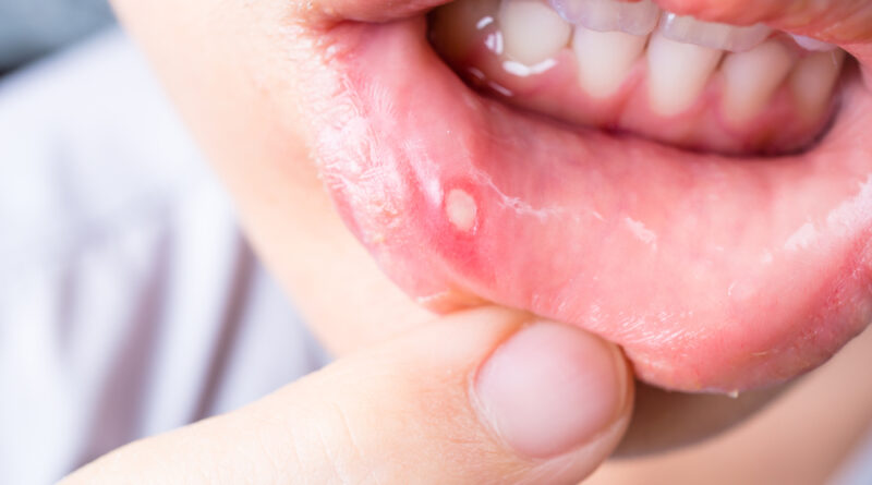 How to Get Rid of a Canker Sore in 24 Hours