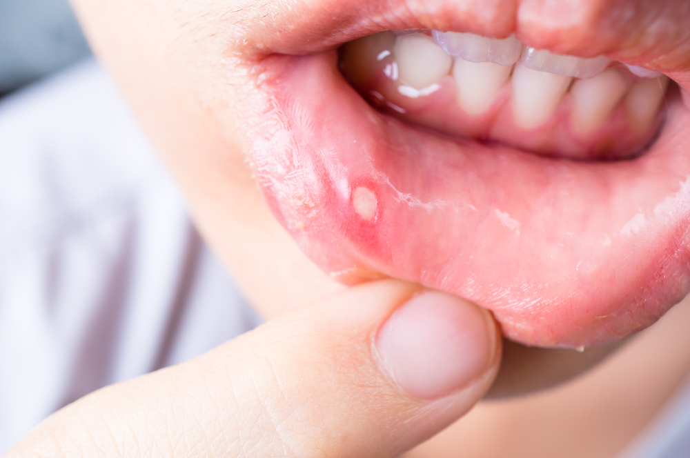 How to Get Rid of a Canker Sore in 24 Hours: Fast Relief Methods That Work